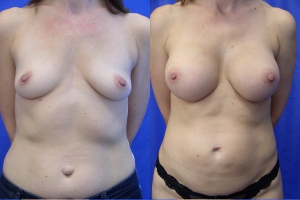 Breast Augmentation (Breast Enlargement)