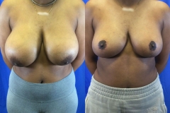 breast-reduction-patient12