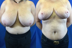 breast-reduction-patient13