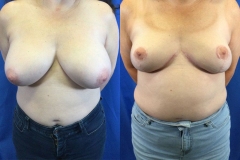 breast-reduction-patient14