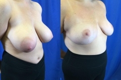 breast-reduction-patient15