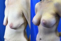 breast-lift-patient16