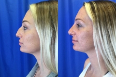 rhinoplasty-patient5