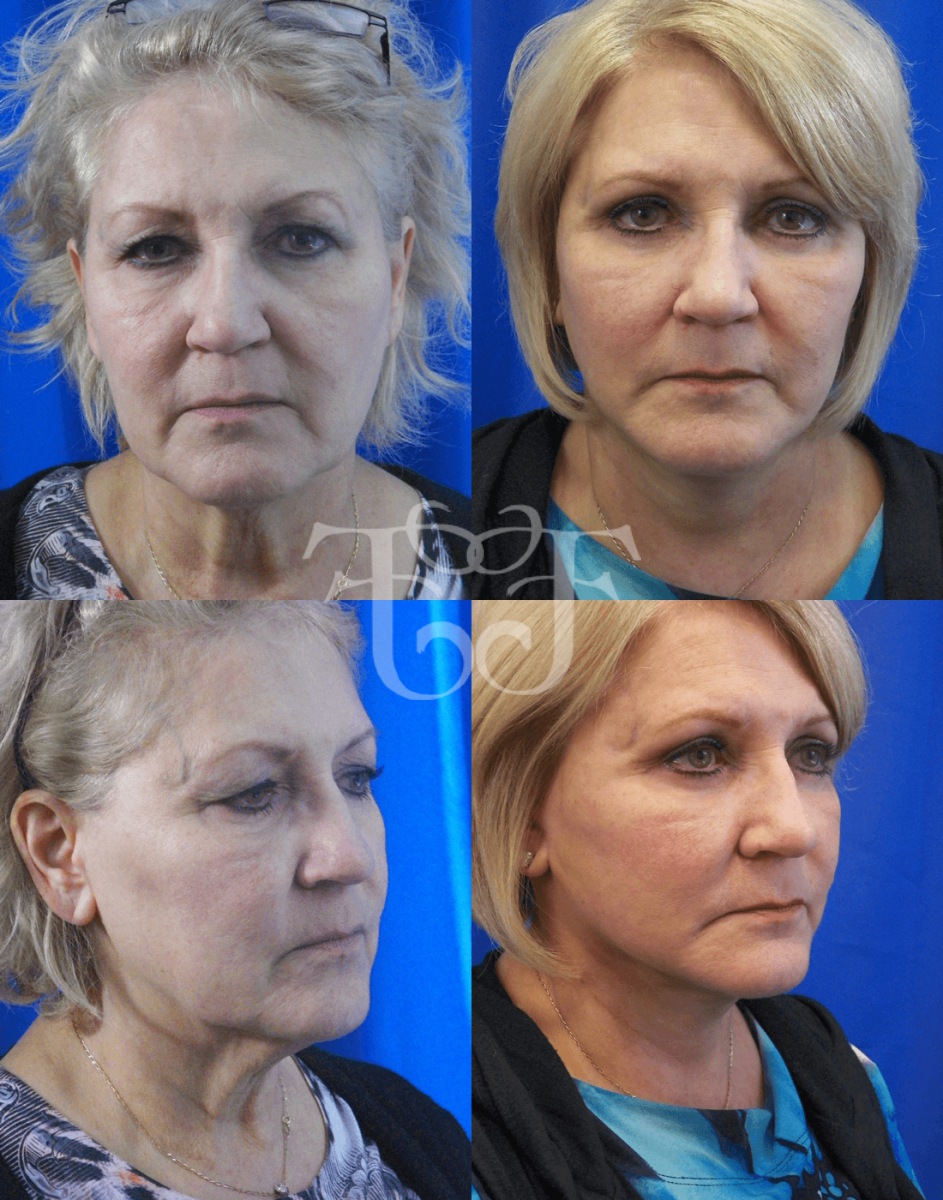 Foglietti Natural (Vector) Facelift℠ Before After Photos Cleveland
