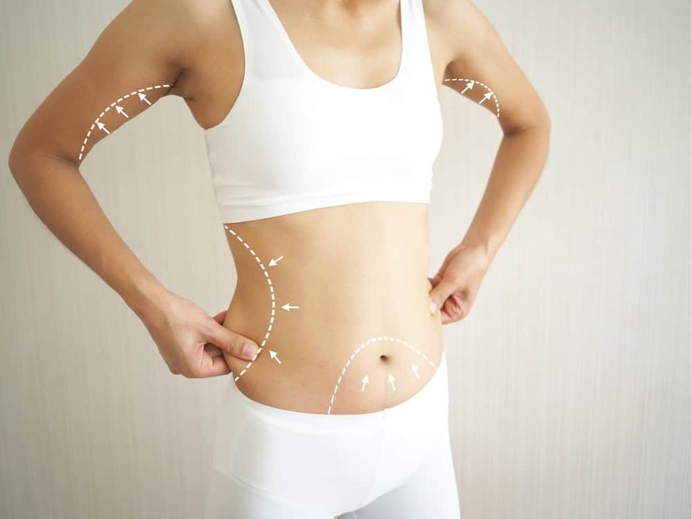 Liposuction Procedure in Beachwood, OH