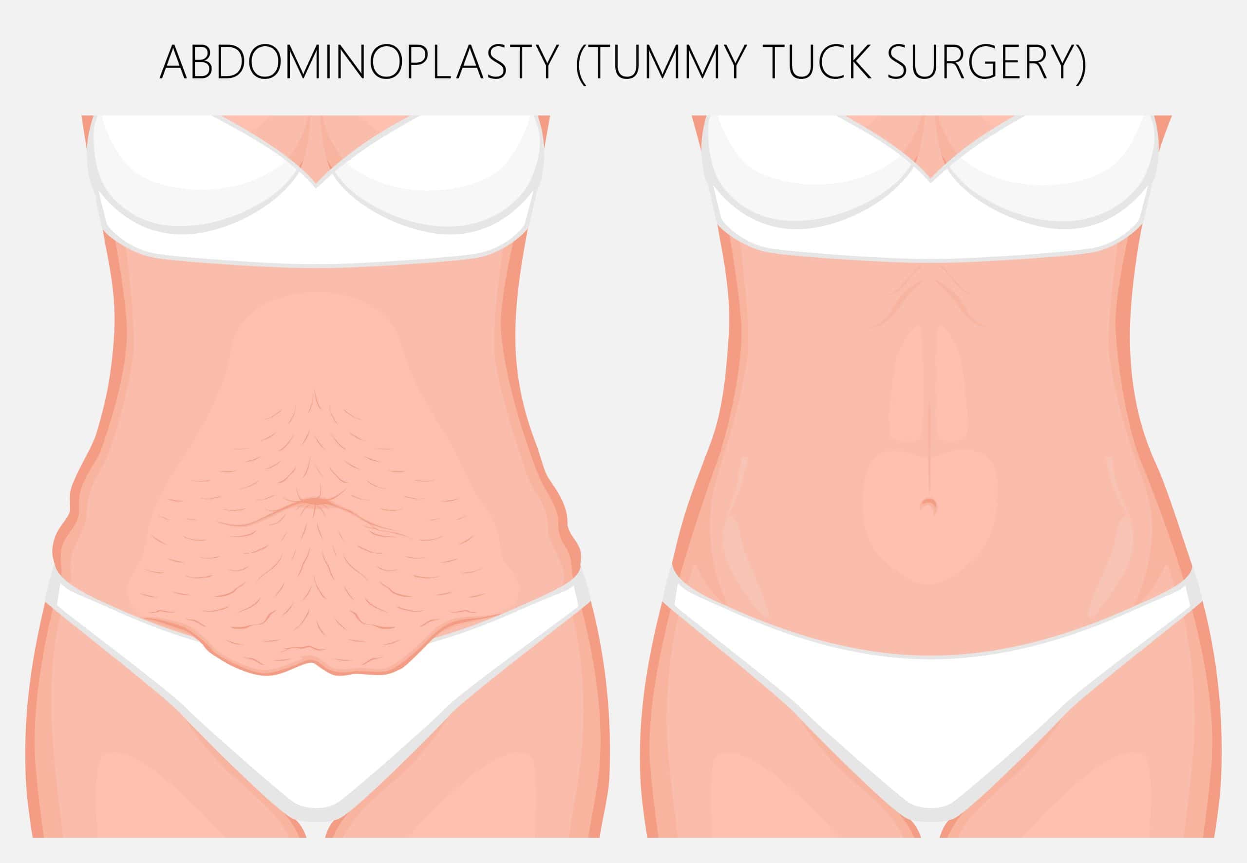 Labiaplasty vaginal rejuvenation in Beachwood, OH